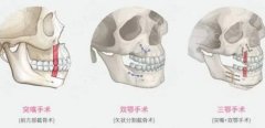 正颌手术对人一辈子的影响有多大？正颌手术安全吗？