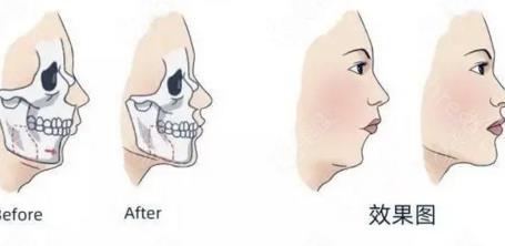正颌手术对人一辈子的影响有多大？正颌手术安全吗？