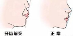 上颌骨性凸嘴有必要做正颌手术吗？上颌骨性凸嘴治疗费用多少钱？