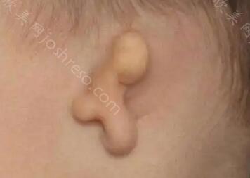 耳朵矫正大概需要多少钱？耳朵矫正费用受哪些因素影响？
