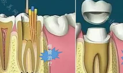 做了根管治疗后牙齿痛怎么办？牙痛治疗期间注意事项有哪些？