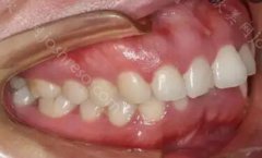 深覆合矫正后脸型的变化？深覆颌矫正方法有哪些？