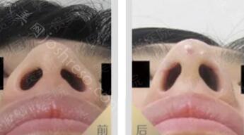 鼻翼缩小1到7天恢复过程图片，鼻翼缩小一般几天恢复？