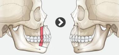 什么是牙槽骨突出图片，牙槽骨突出如何改善？