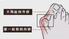 做大脚骨手术有危险吗？大脚骨整形多少钱？大脚骨整形多久能恢复？