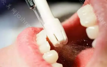 喷砂洗牙适合哪些人群？武汉有没有洗牙效果好的口腔医院推荐？