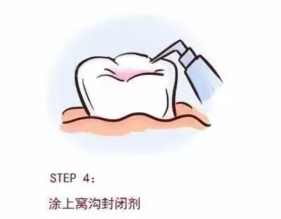 北京维乐口腔科普|儿童口腔预防窝沟封闭的优缺点有哪些？
