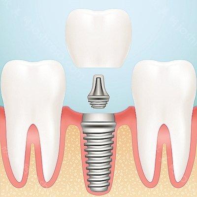 医生告诉您如何延长种植牙寿命