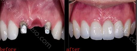 多颗牙齿缺失能采用什么方法修复