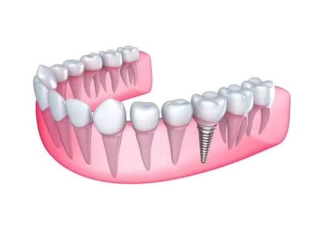 上海口腔医生解析：种植牙是什么