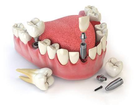 种植牙比传统假牙有哪些优点