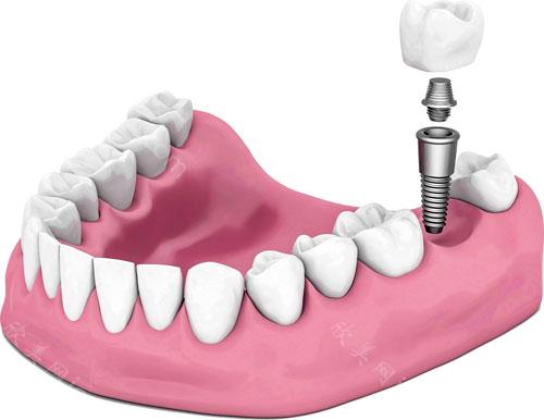 上海做种植牙治疗需要多长时间