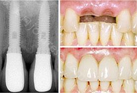 牙齿缺失进行种植牙修复有哪些优势