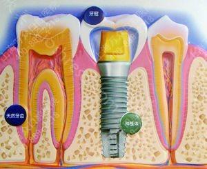 种植牙 将牙齿定格在黄金年代