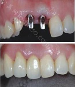 解析：老人缺牙该怎么办 什么方法修复好