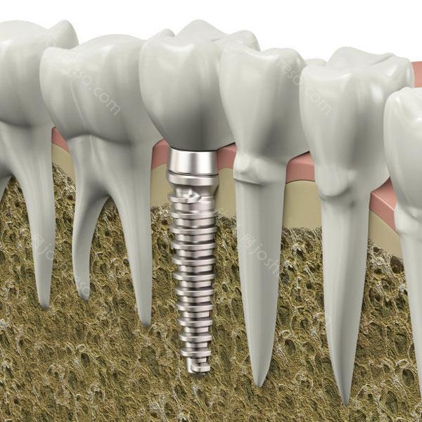 上海做种植牙有哪些种类
