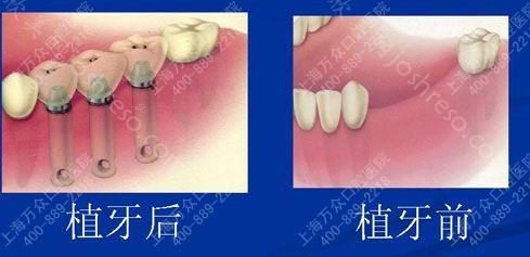 种植牙保养得宜终身享受