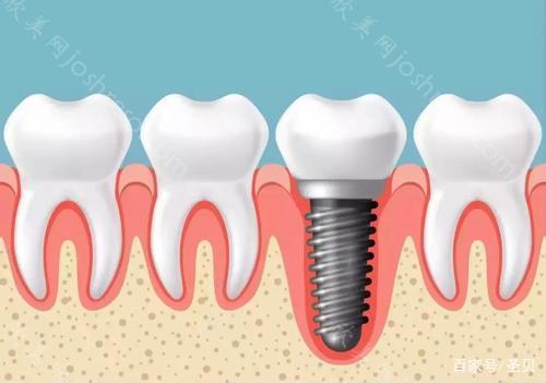 为什么牙齿缺失选择种植牙