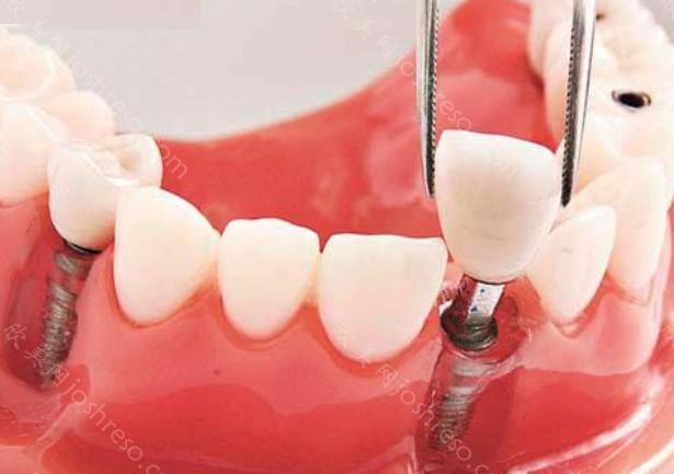 成年人牙齿缺失的时候可以做种植牙吗