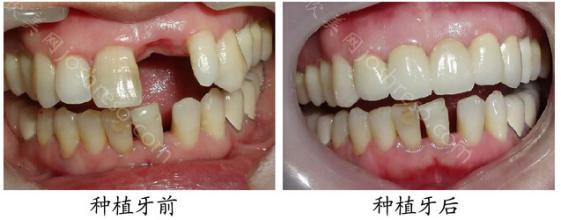 较常用的种植牙修复方式有哪些