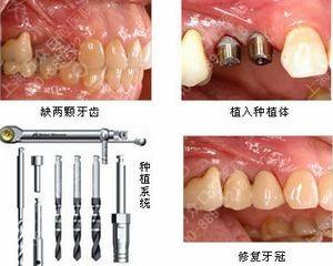 在专业口腔医院做种植牙的一般费用怎么样