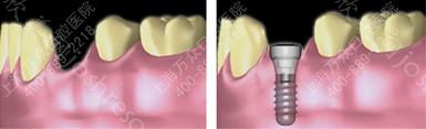 种植牙 让缺牙再现好