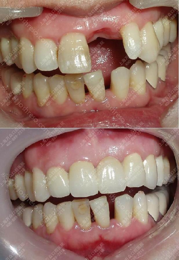 种植牙修复 让整牙更安全