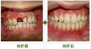 上海进行种植牙修复牙齿的天然优势有哪些