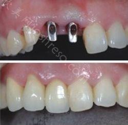 种植牙修复牙齿的优点有哪些
