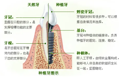 做了种植牙有危害吗?为什么有人做了种植牙就不想活了