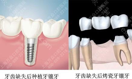 种植牙修复优点 绽放甜美笑容