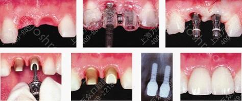 单颗种植牙 快速种植终生受益