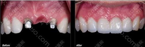 种植牙修复效果怎么样 营造真牙气质