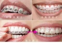 北京私立口腔医院牙科收费标准，包括正畸/种植等价格