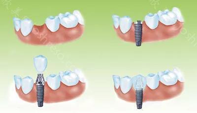 种植牙—突破传统的修复牙技术