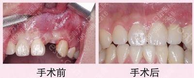 种植牙 专业修复牙齿医生