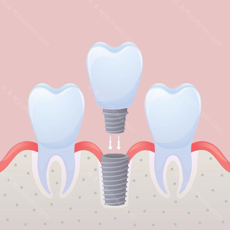种植牙，牙齿修复中的贵族