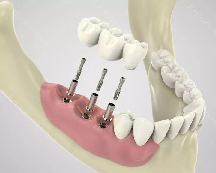 老人活动义齿修复需要注意的问题有哪些