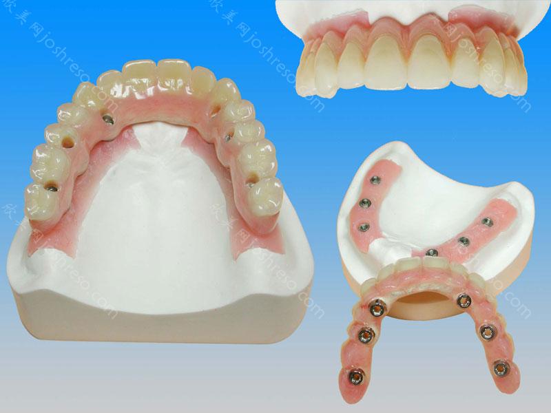牙龈萎缩能做种植牙吗