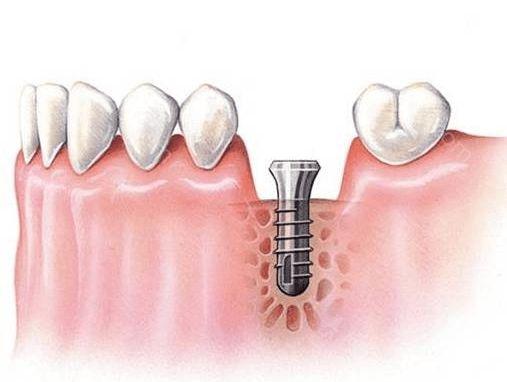 哪些因素会影响种植牙的寿命？