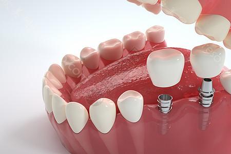 种植牙——牙缺失患者的福星