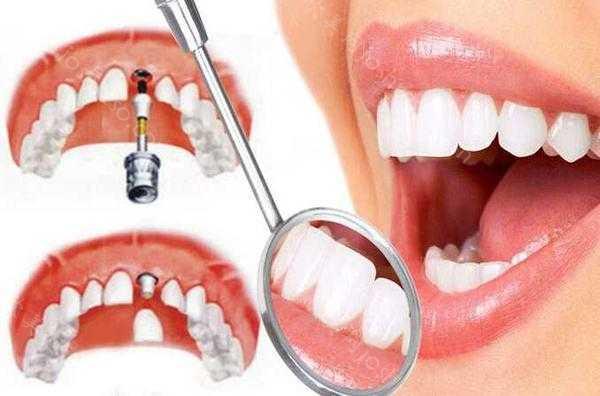 种植牙术前检查需确定哪些问题