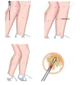 全身吸脂多少钱?含大腿抽脂价格一览表