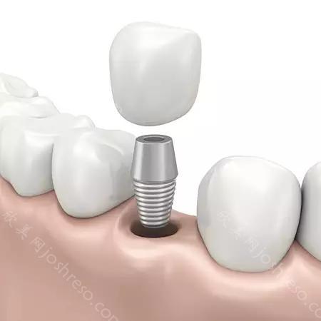 牙齿缺失怎么办 选择种植牙修复