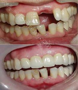 口腔内做种植牙的适应症一般都有哪些