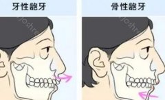 骨性凸嘴和齿性凸嘴区别图片，凸嘴矫正案例分享！