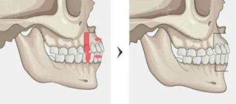 骨性凸嘴和齿性凸嘴区别图片，凸嘴矫正案例分享！