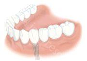 一颗种植牙的平均使用寿命是多久