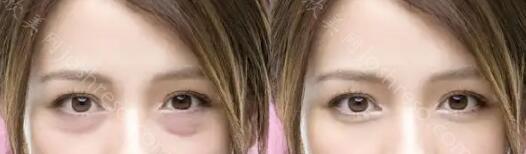 去眼袋手术图片对比？去眼袋哪种方法比较好？
