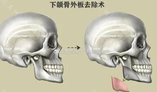 上海第九整形医院哪个做下颌骨截骨手术好？上海九院截骨手术案例分享！